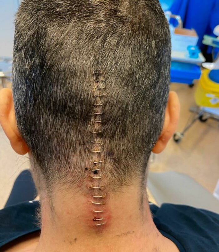 Efter operationen. Foto: Privat. Rundiks bakhuvud och ärr efter operationen
