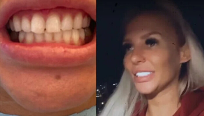 Paulinas tänder före och efter behandlingen. Foto: Instagram/kattpaow. paulina danielssons tänder innan och efter ingreppet hollywood smile