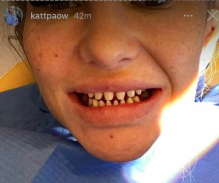 Nedslipade s.k "vampyrtänder". På dessa fastsätter man kronor och/eller fasader. <br>Foto: Instagram/kattpaow. Nedslipade vampyrtänder