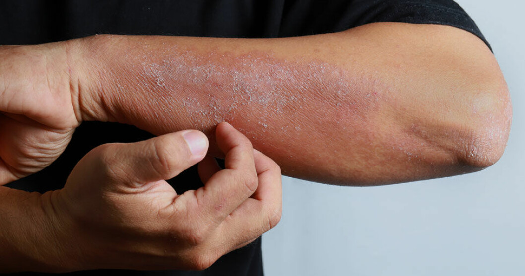 Det finns olika typer av psoriasis. Det finns olika typer av psoriasis.