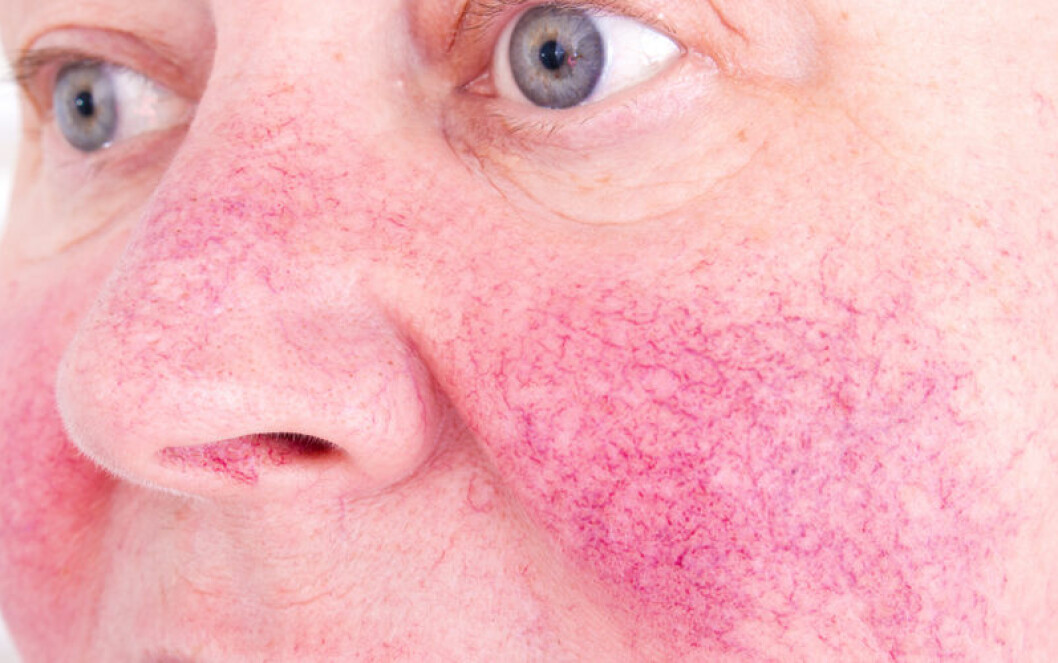 Rosacea innebär ytliga blodkärl och rodnad på huden. Rosacea innebär ytliga blodkärl och rodnad på huden.