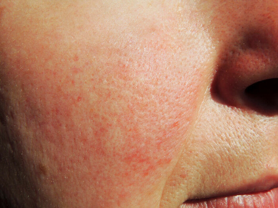 Rosacea. Rosacea.