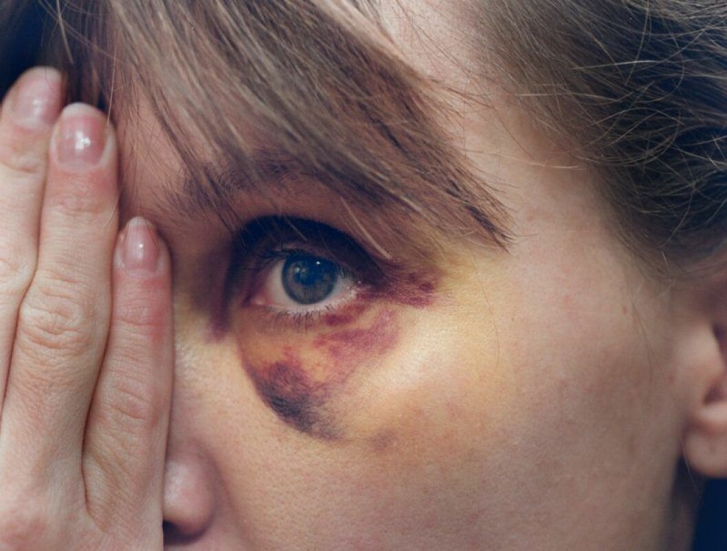 ”Du vet aldrig när misshandeln går över i dödligt våld”, säger Åsa. Kvinna med blåtira.