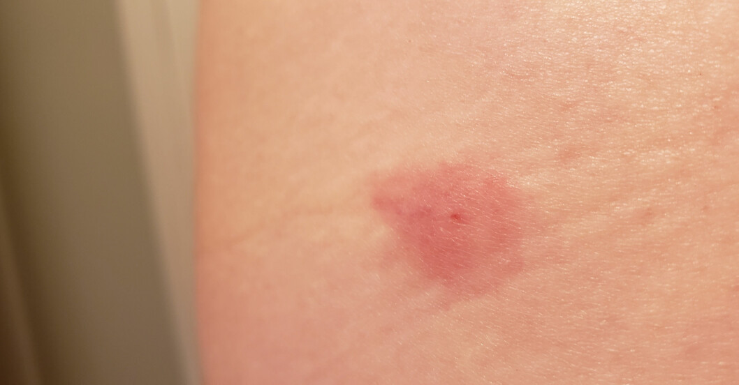 Bromsbett blir större än myggbett och man kan till och med få ett blåmärke. Lindrigt bromsbett på en bit hud.
