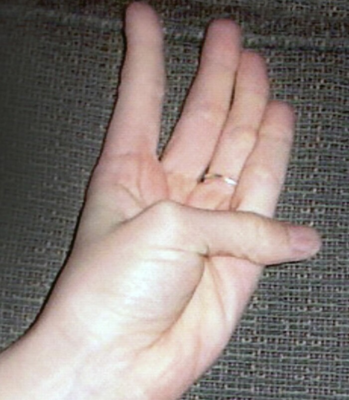 Så ser en överrörlig tumme ut. Foto: Så ser en överrörlig tumme ut