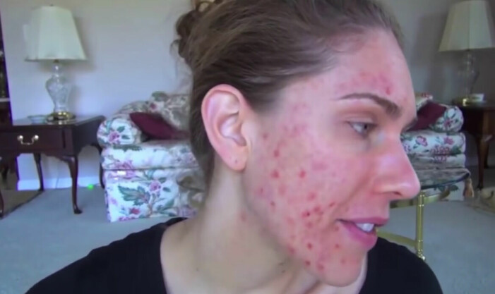 Cassandra Bankson led längre av smärtsam acne.