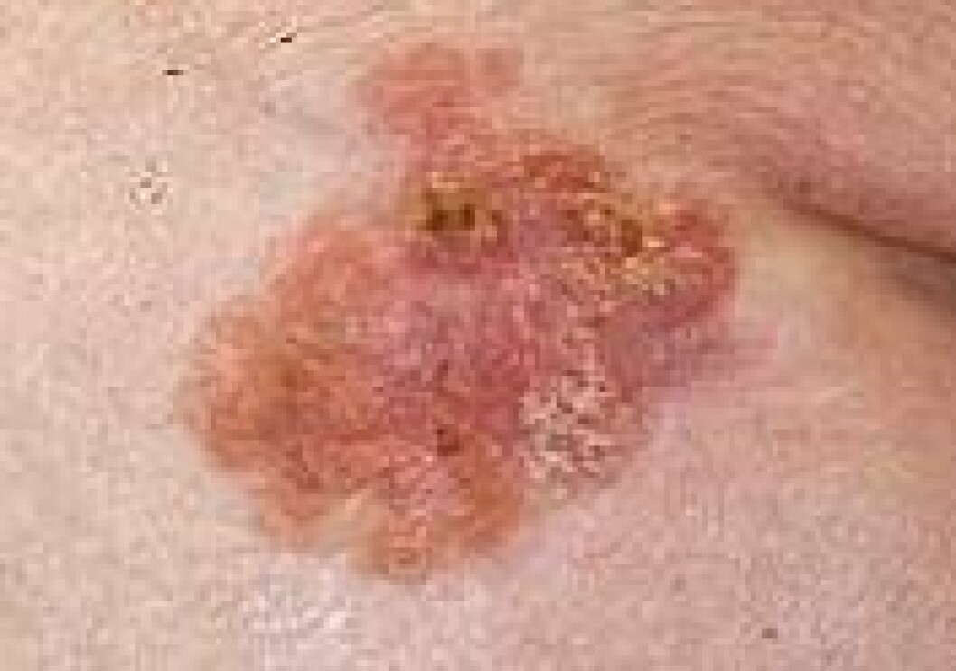 Skivepitelcancer.