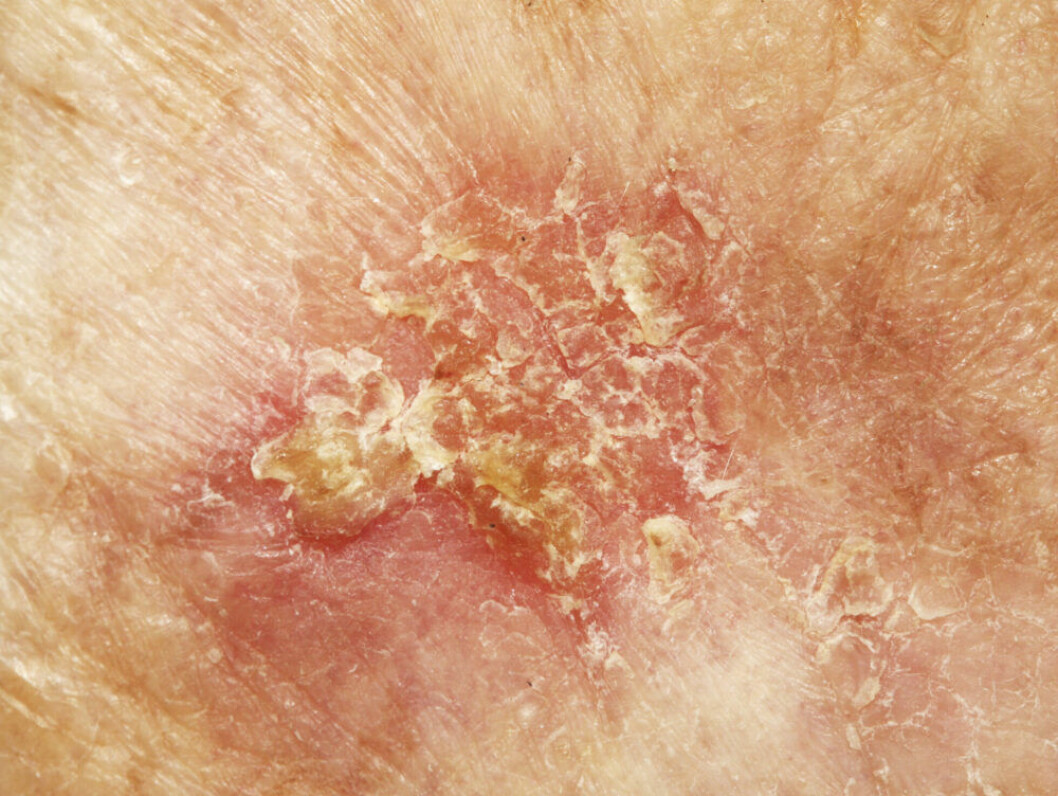 skivepitelcancer.