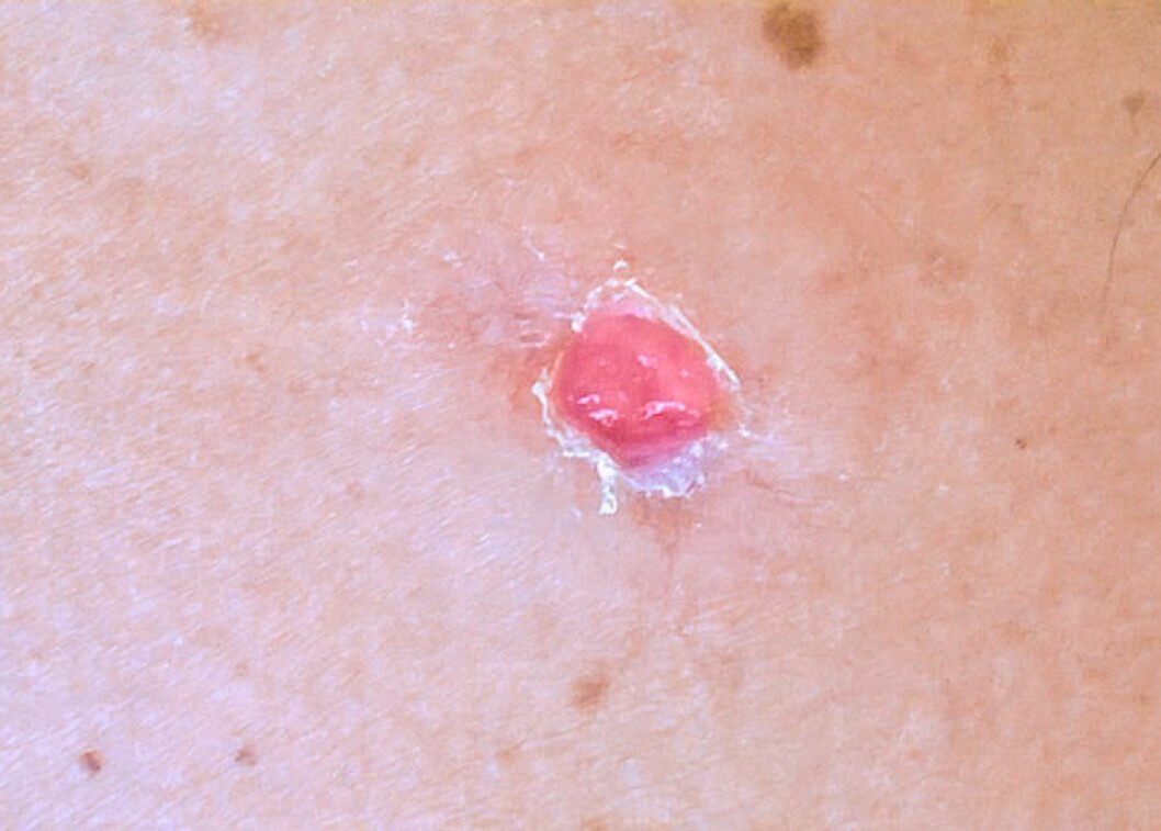 Skivepitelcancer  