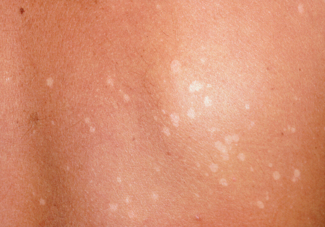 svamp, pityriasis versicolor