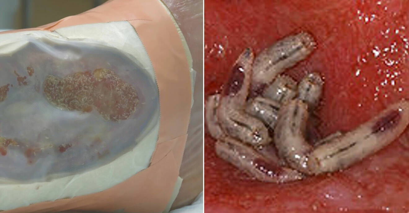 Svårt infekterat sår med larver i, och larver som jobbar i såret