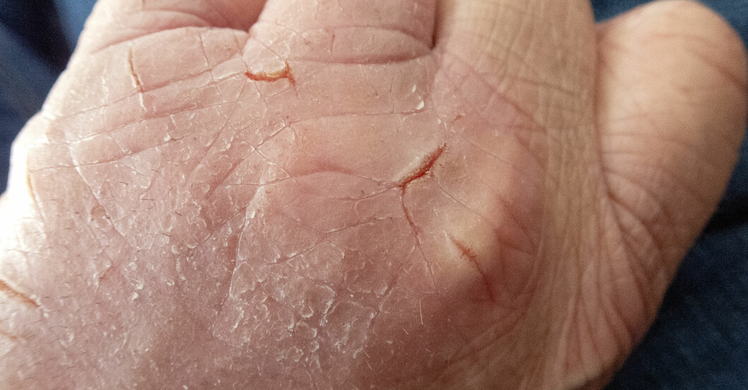 Torr hand med sprickor