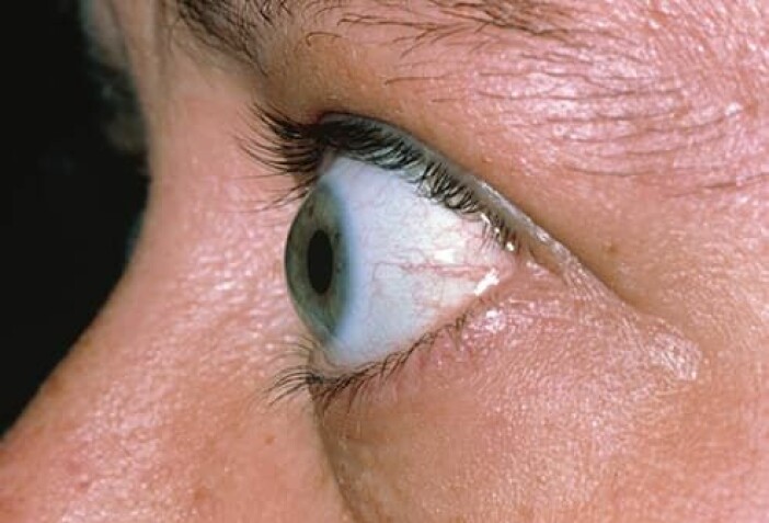 Ögonglober som står ut kan vara tecken på sjukdom, men behöver inte vara det. Foto: WebMd. Person med utpekande ögonglobar