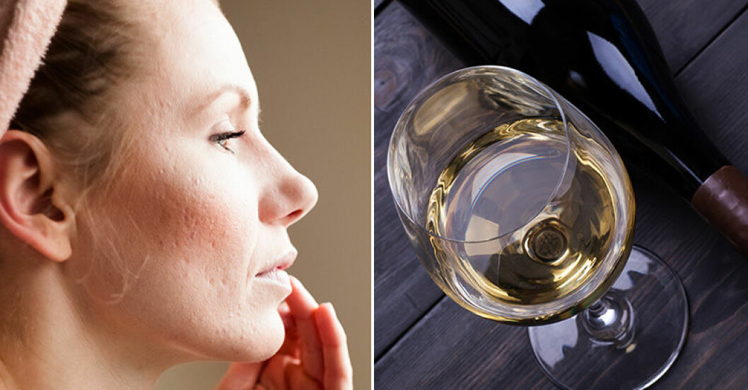 Vitt vin kan öka risken att drabbas av hudsjukdomen Rosacea